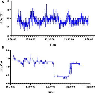 Utility of sample entropy from intraoperative cerebral NIRS oximetry data in the diagnosis of postoperative cognitive improvement